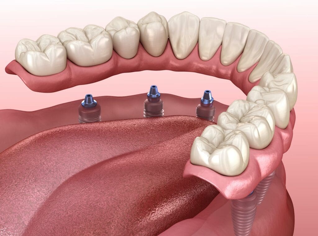 All-on-4 Dental Implants in Center Valley, PA