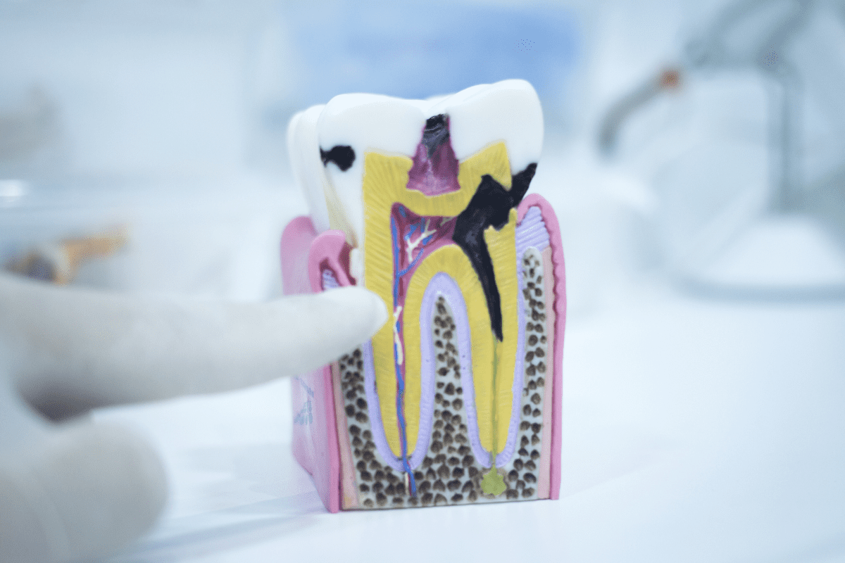 6 Signs of Tooth Decay You Shouldn’t Ignore - Center Valley PA