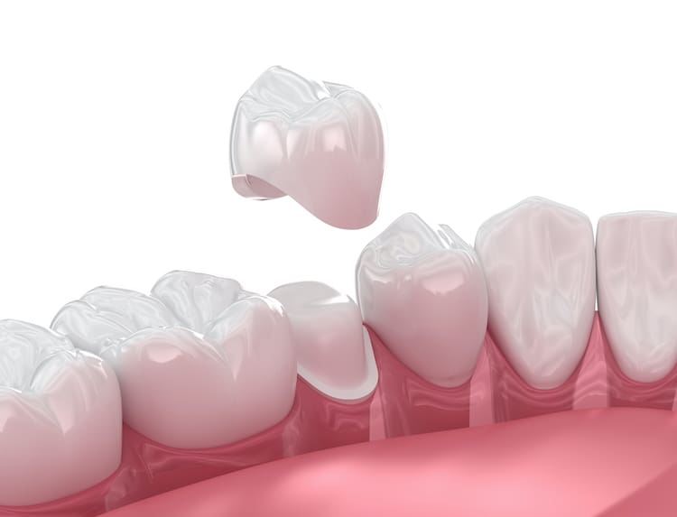 Staying calm and knowing how to respond can help protect both your tooth and dental crown until you can see your dentist.