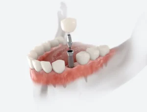 You May Still Qualify for a Dental Implant in Bethlehem, PA