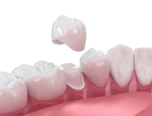 Same-Day Dental Crowns vs. Traditional in Allentown, PA